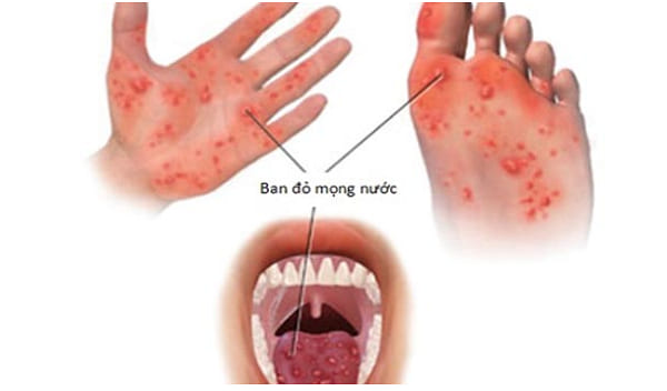 Dấu hiệu của bệnh chân tay miệng