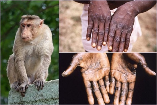 Virus đậu mùa khỉ
