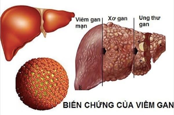 Biến chứng viêm gan B