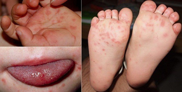 Bệnh tay chân miệng là gì? Dấu hiệu và các điều trị cho trẻ