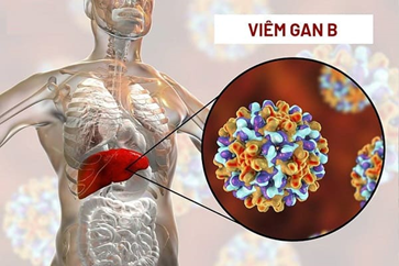 Viêm gan B: Nguyên nhân, triệu chứng, chẩn đoán và điều trị